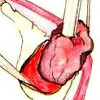 Удаление ретенционной кисты слюнной железы