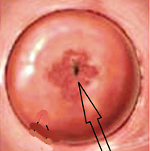 Эктопия шейки матки