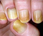 Синдром желтого ногтя 