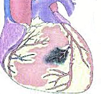 Постинфарктная стенокардия