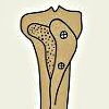Корригирующая высокая остеотомия большеберцовой кости
