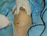 Процедура Артроскопия коленного сустава