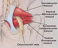 Синдром грушевидной мышцы