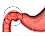 Диета при воспалении желудка и двенадцатиперстной кишки и пищевода