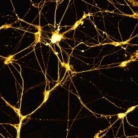 Ученые поняли, как развивается деменция Ученые поняли, как развивается деменция