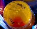 MRSA-инфекция MRSA-инфекция