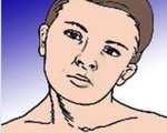 Болезнь Гризеля