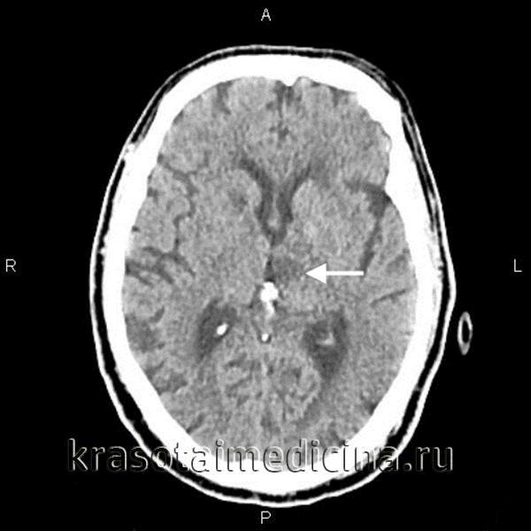 КТ головного мозга. Лакунарный инфаркт в области левого таламуса