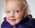 Перелом носа у ребенка