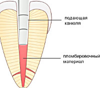 Процедура Пломбирование корневого канала
