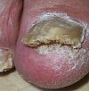 Курс лечения грибковых поражений ногтей