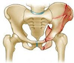 Перелом костей таза у беременных