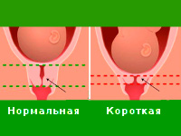 Короткая шейка матки при беременности