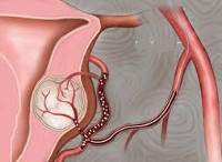 Процедура Эмболизация маточных артерий при миоме