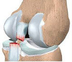 Надрыв связок коленного сустава — лечение и сроки восстановления, симптомы и признаки частичного надрыва боковой связки