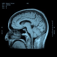 Уровень железа на МРТ покажет влияние инсульта на мозг