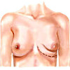 Эндопротезирование груди тубулярной формы