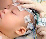 Доброкачественная миоклоническая эпилепсия младенчества