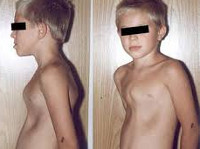 Деформации грудной клетки у детей