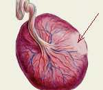 Инфаркт плаценты