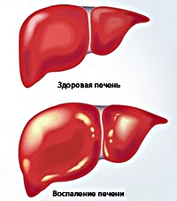 Реферат: Хронические гепатиты, лечение, патогенез