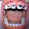 Серебрение зубов