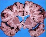 Лейкоареоз головного мозга