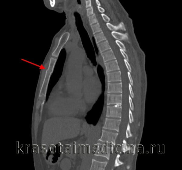 КТ ОГК. Поперечный перелом тела грудины с незначительным смещением отломков по ширине