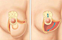 Процедура Редукционная маммопластика