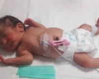 Синдром Йохансона-Близзарда Синдром Йохансона-Близзарда