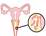Бактериальный вагиноз