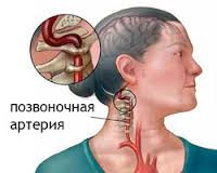 Синдром позвоночной артерии
