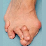 Деформация пальцев ног