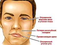 Стволовой инсульт