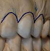 Удлинение коронковой части зуба