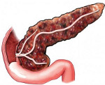 Фиброз поджелудочной железы