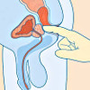 Пальцевое ректальное исследование простаты