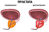 Простатит