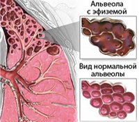 Подкожная эмфизема: особенности заболевания, симптоматика недуга, клиническая картина, диагностические исследования, методы лечения, возможные осложнения