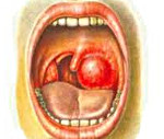 Паратонзиллярный абсцесс