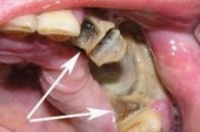 Зубы остеомиелит