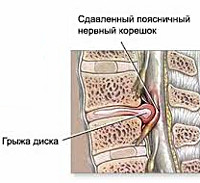 Межпозвоночная грыжа поясничного отдела