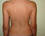 Синдром плоской спины