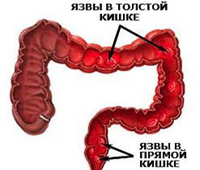 Неспецифический язвенный колит 