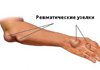 Лечение при ревматизме суставов у детей thumbnail