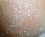 Дырочки на стопах что делать. Смотреть фото Дырочки на стопах что делать. Смотреть картинку Дырочки на стопах что делать. Картинка про Дырочки на стопах что делать. Фото Дырочки на стопах что делать