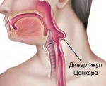Дивертикул Ценкера