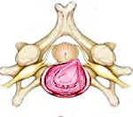 Межпозвоночная грыжа шейного отдела