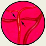 Окклюзия центральной артерии сетчатки