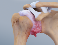 Adhäsive Kapsulitis